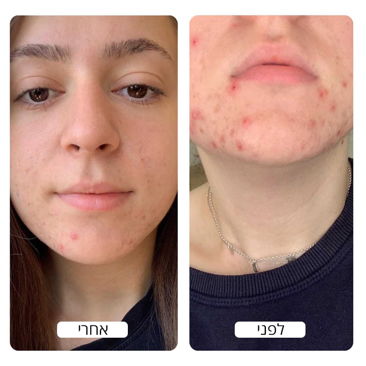 Before_and_After_Acne_Results_bu_Spacetouch_750x_crop_center-min