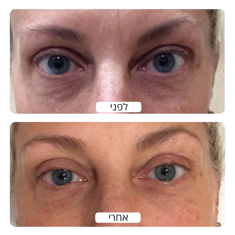 Before_and_after_LED_device_results_by_Spacetouch_750x_crop_center-min