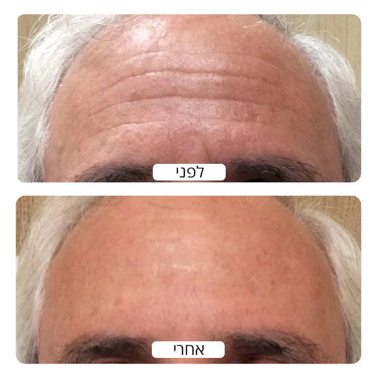 Forehead_wrinkles_before_and_after_results_by_Spacetouch_750x_crop_center