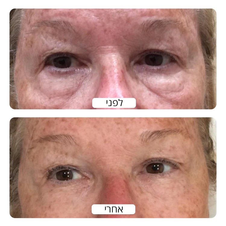Under_eye_bags_Before_and_after_results_by_Spacetouch_750x_crop_center-min