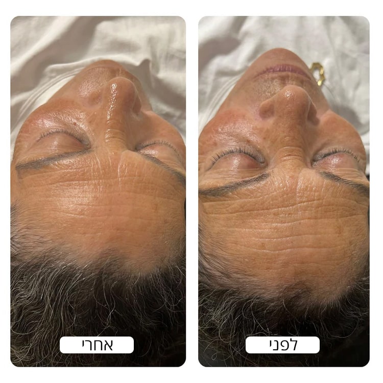 Before_and_after_aging_results_by_Spacetouch_750x_crop_center-min
