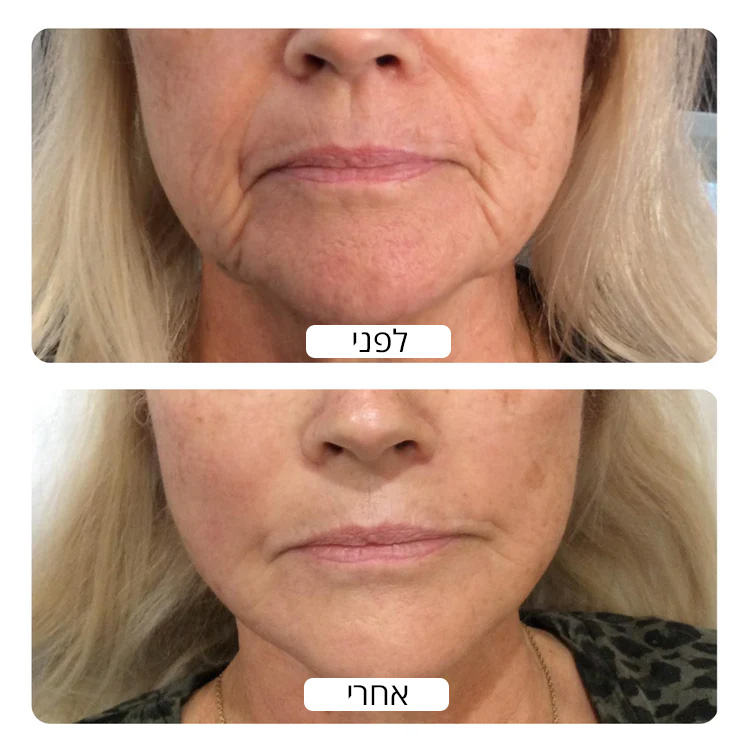 Chin_Wrinkle_before_and_after_results_by_Spacetouch_750x_crop_center