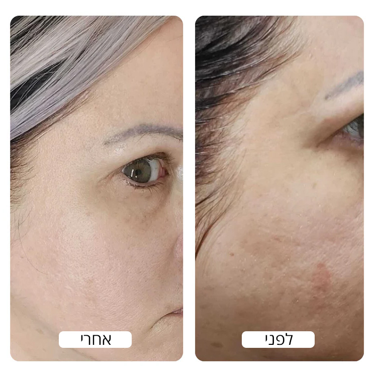 Oily_Skin_Before_and_after_photo_by_Spacetouch_750x_crop_center
