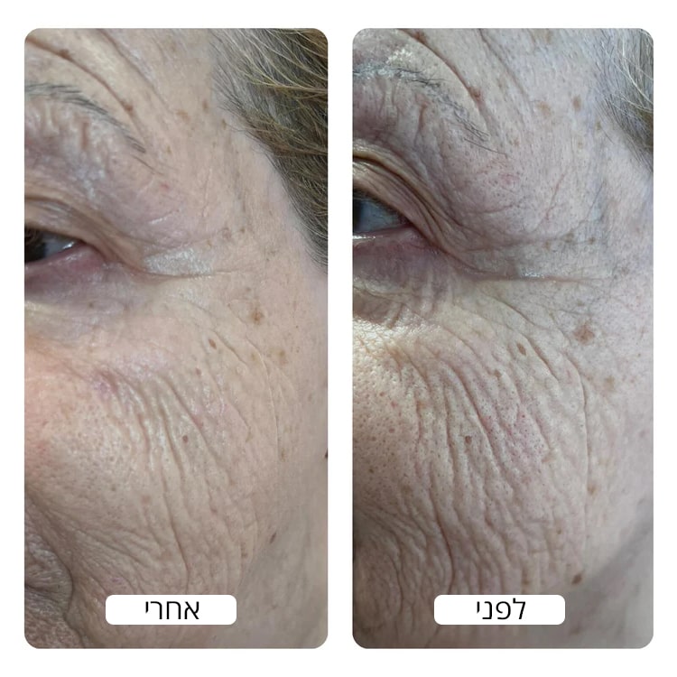 Wrinkle_Before_and_After_by_Spacetouch_750x_crop_center-min